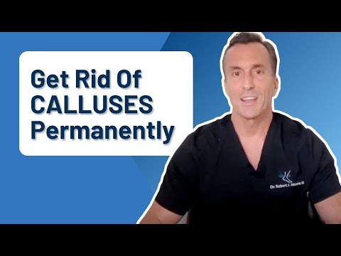 How Do You Get Rid Of Calluses Permanently?