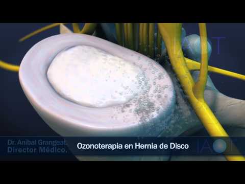 IAOT 3D Ozonoterapia en Hernia de Disco