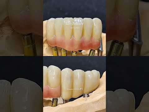 All Zirconia Crown Case Study~~!