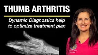Motion x-ray can see cause of thumb arthritis and help optimize a treatment plan