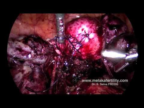 Laparoscopic cystectomy and myomomectomy for severe endometriosis  and fibroids