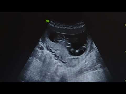 12-WEEK-OLD BABY PLAYS IN ITS MOTHER'S WOMB