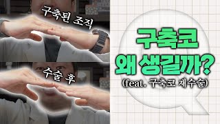 구축코 왜 생길까? 구축코 재수술했는데 또 구축이..? (Feat. 구축코 재수술)