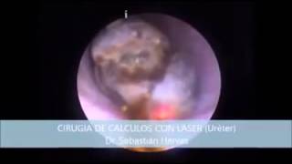 Cirugia de calculos, Dr. Sebastian Hervas