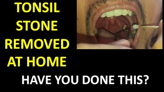 Tonsil Stone Removal: How to remove tonsil stones at home