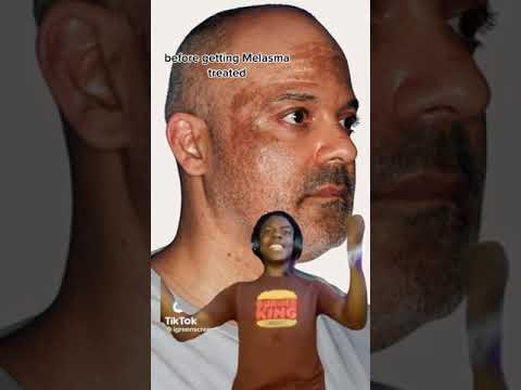 Say goodbye to your Melasma! Lets restore your confidence with a fresh glow✨🤌🏼 #shorts #melasma