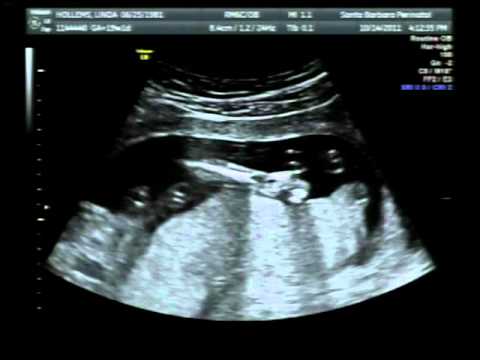 Ultraljud vecka 19 + 2 dagar