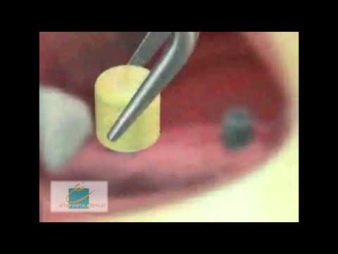 Medellin Dental Cluster | Dental Implants Information | Medellin, Colombia 