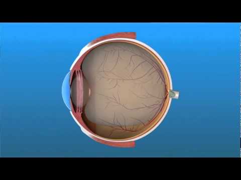 Vitrectomy Surgery for Detached Retina