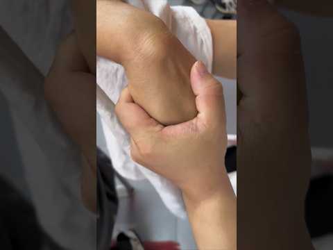 E1167 The lady's😮🥚lump on her hand,😁😘🌹as big as an egg,was eliminated,and she revealed a happy smile