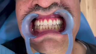 Calidad a nivel internacional – Clínica dental Ciudad de México – Implantes dentales All-On-4