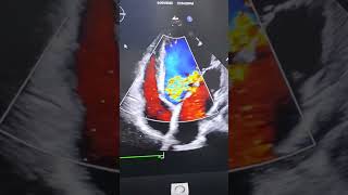 Download lagu #aortic_valve_insufficiency in #2decho #aortic_valve_insufficiency #cardiacrehab #ar mp3 Download lagu #aortic_valve_insufficiency in #2decho #aortic_valve_insufficiency #cardiacrehab #ar mp3