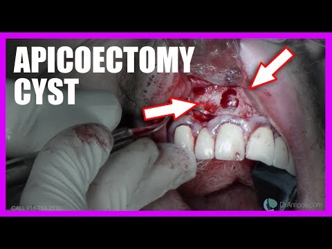 Apicoectomy Cyst Surgery