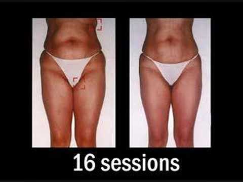 Mabilis na pagbaba ng timbang na tsokolate Kung paano alisin cellulite sa pamamagitan ng operasyon