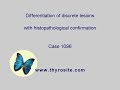 Differentiation Of Discrete Lesions Case 1096