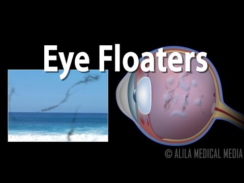 image-What does fluid in the eye mean?
