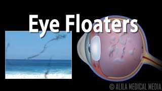 Eye Floaters and Flashes, Animation.