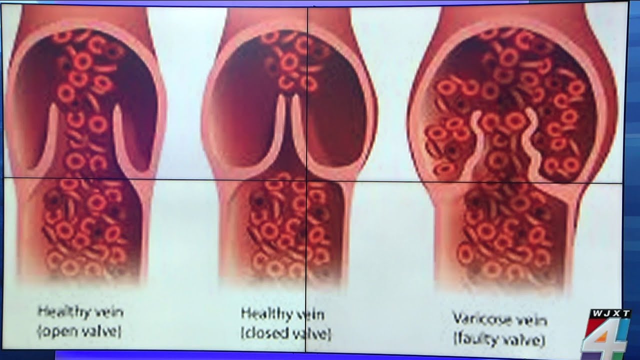 Heart & vascular expert explains President Trump's 'chronic venous insufficiency'