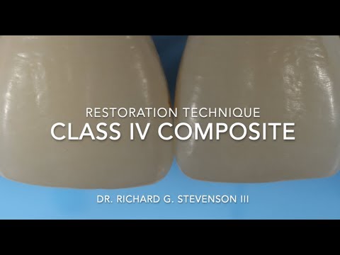 Class IV Composite Restoration