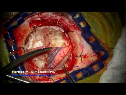 Brain tumor and awake brain surgery (Dr F. Limonadi)