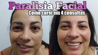 PARALISIA FACIAL: CURA EM 4 SESSÕES - DR ROMULO PIMENTA