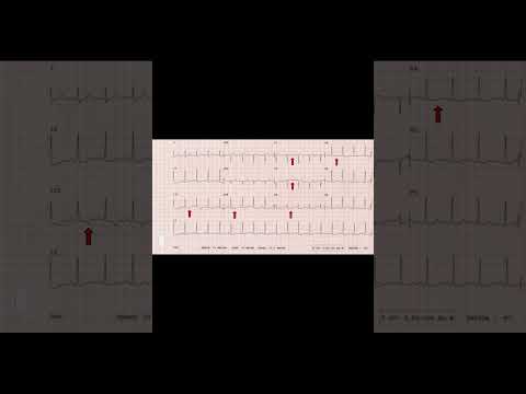 CXR & EKG Findings in Pulmonary Embolism Explained | #meded #emergencymedicine #criticalcare