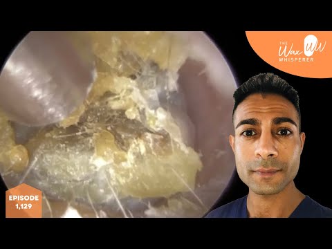 1,129 - Very Dry Itchy Dead Skin & Ear Wax Removal