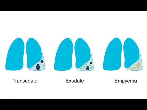 How to recognize different pleural effusions on chest CT