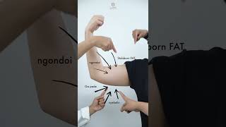 Download lagu Lemak di lengan hilang hingga 25% secara permanen - La Lumiere Aesthetics mp3