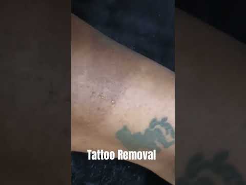 Tattoo Removal in Subang Jaya