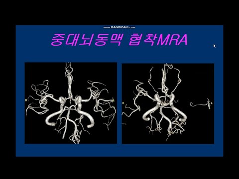 중대뇌동맥 협착MRA