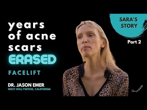 Before & After Facelift Transformation: Woman Has YEARS of Acne Scars Erased! Part 2