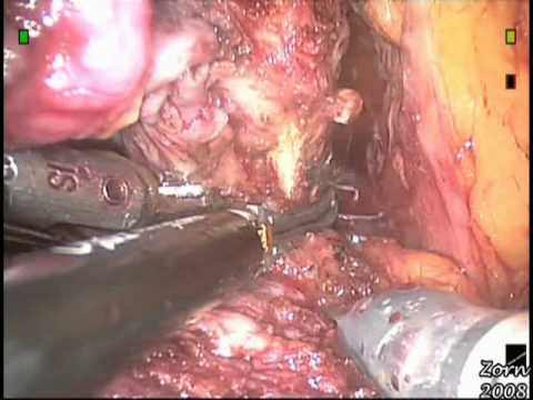 Robotic Radical Prostatectomy - STEP 7-  Non-nerve Sparing Technique