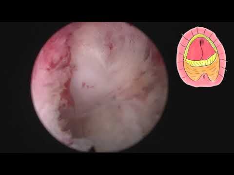 En Bloc MoLEP With Early Apical Release