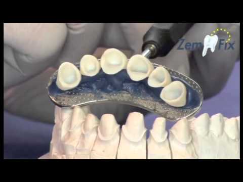 ZemFix® - Das Innovative Zementieren (Patented)