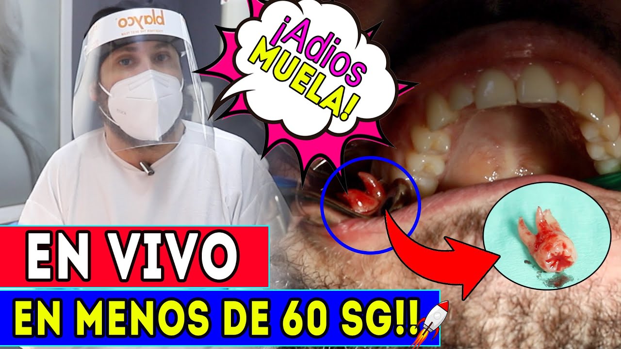 [En 𝐕𝐈𝐕𝐎🔴] Como se EXTRAE una MUELA del JUICIO en 𝗠𝗘𝗡𝗢𝗦 𝗱𝗲 𝟲𝟬 𝘀𝗴! (🚀𝙐𝙡𝙩𝙧𝙖Rápido y SIN DOLOR)