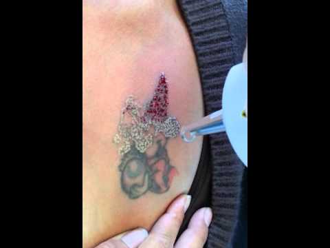 How To Remove Tattoos?