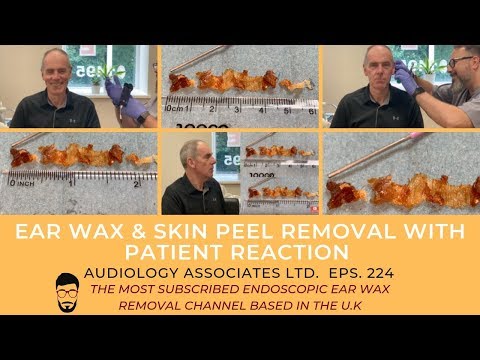 EAR WAX & SKIN PEEL REMOVAL WITH PATIENT REACTION - EP 224