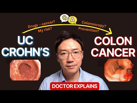Colon Cancer in Crohn’s & Ulcerative Colitis (IBD): Everything You Need to Know (2026)