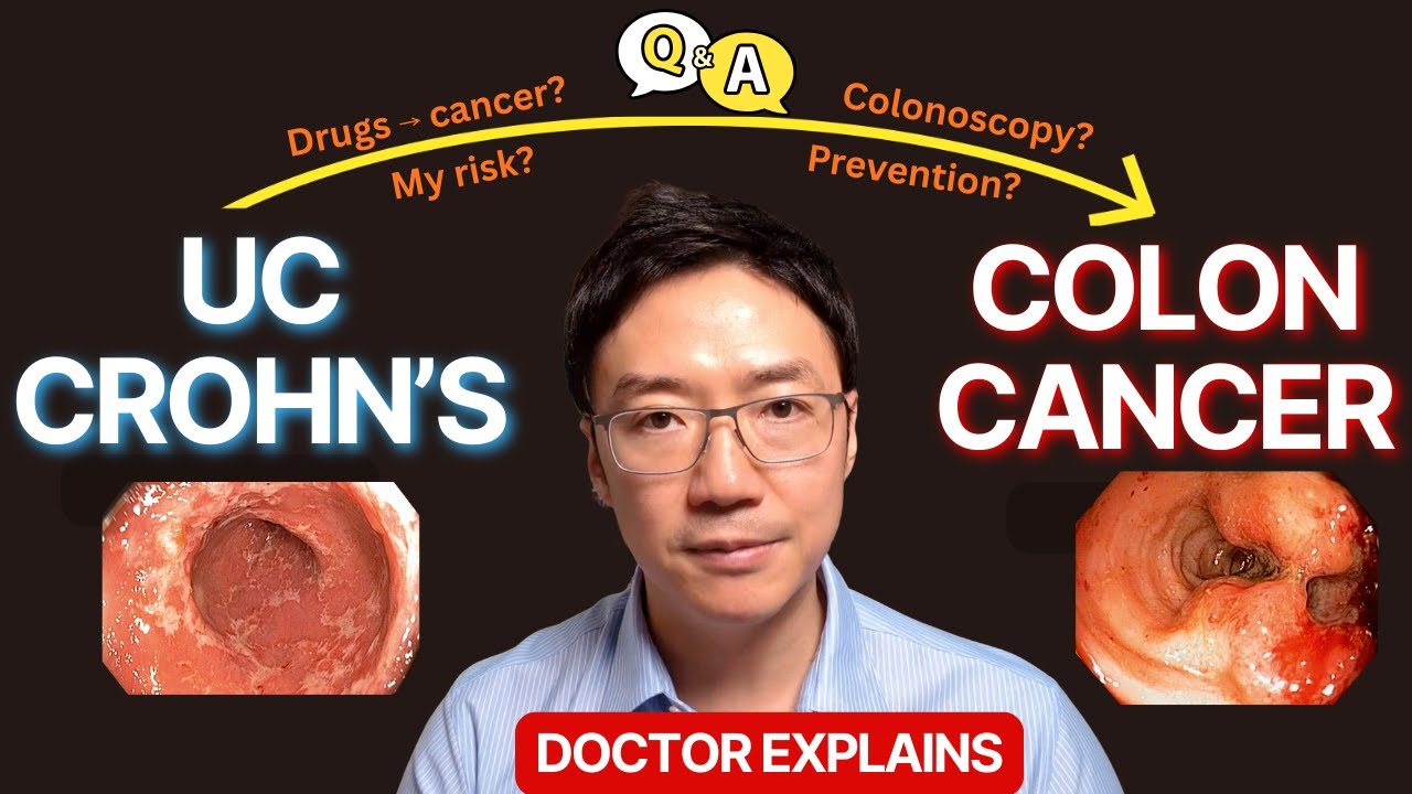 Colon Cancer in Crohn's & Ulcerative Colitis (IBD)