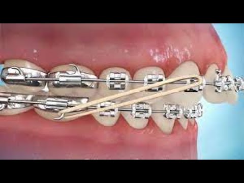 How to put on Class II Elastics