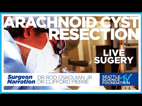 Arachnoid Cyst Resection