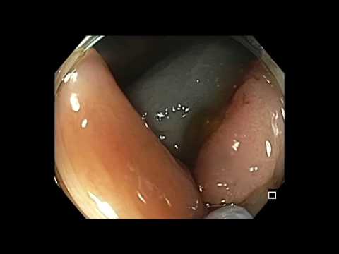 Colonoscopia - RME de lesión LST-NG de colon ascendente