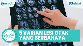 Ada 5 Tipe Lesi Otak yang Membahayakan Nyawa, Berikut Gejala-gejalanya