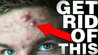 EXACTLY What To Do With A BIG Zit or Cyst! (From Experience)