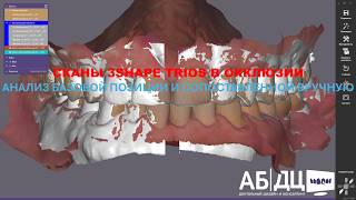 СКАНЫ 3SHAPE TRIOS В ОККЛЮЗИИ - АНАЛИЗ БАЗОВОЙ ПОЗИЦИИ И СОПОСТАВЛЕННОЙ ВРУЧНУЮ