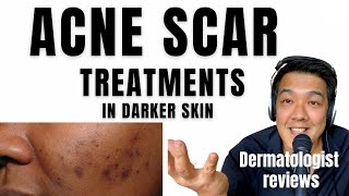 ACNE SCAR TREATMENTS | In Ethnic Skin