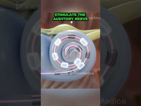 How cochlear implants work (3D Animation)