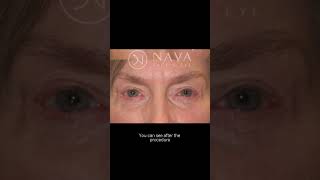 Nava Face & Eye
