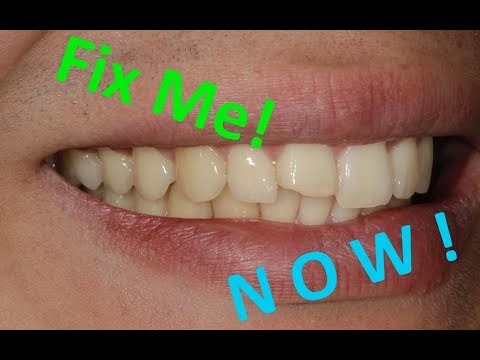 download lagu mp3 mp4 How To Fix A Broken Tooth At Home, download lagu How To Fix A Broken Tooth At Home gratis, unduh video klip How To Fix A Broken Tooth At Home